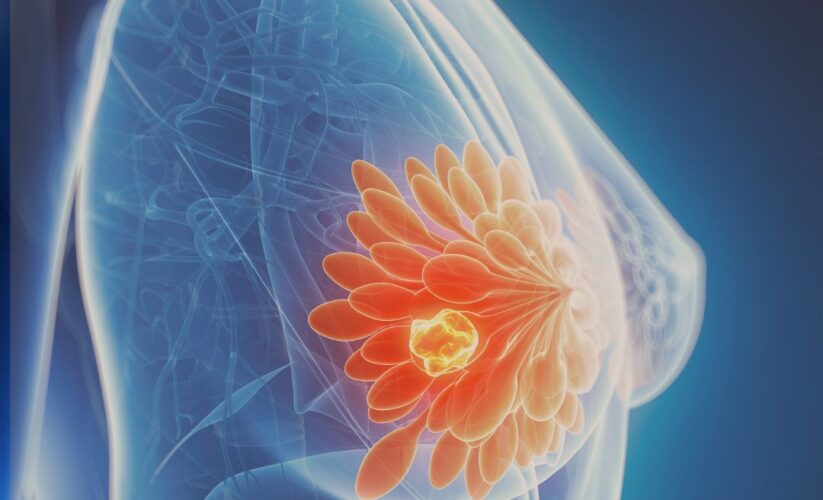 Teleradiology in India: Bridging the Mammography Reporting Gap