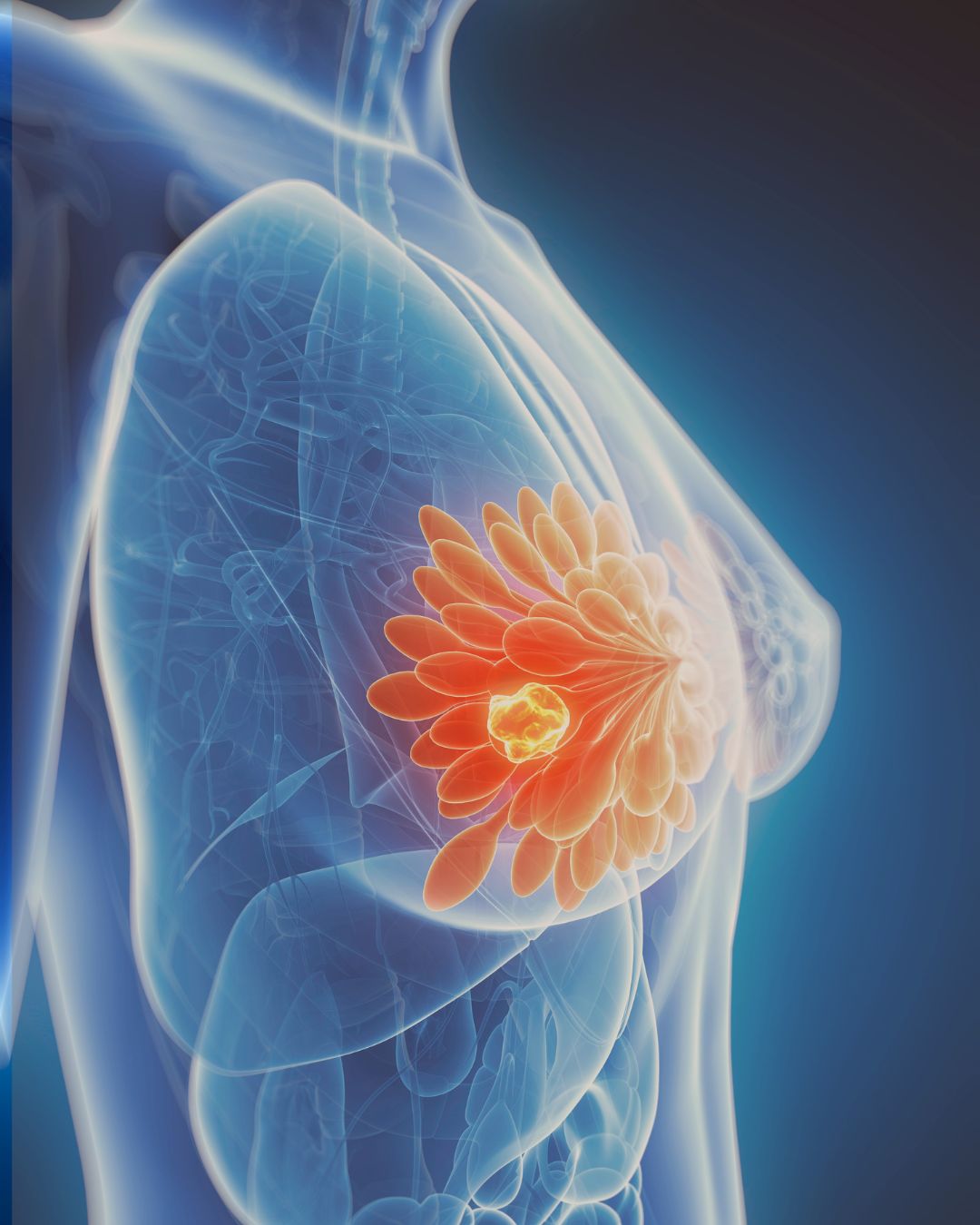 Teleradiology in India: Bridging the Mammography Reporting Gap